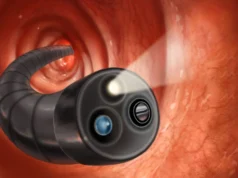 Can a Colonoscopy Detect Cancer Early?